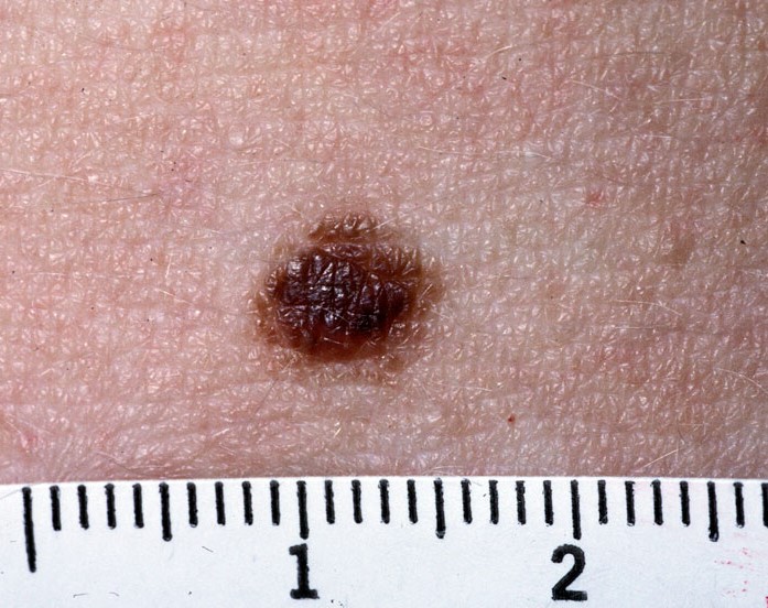 Nevus_NCI.jpg